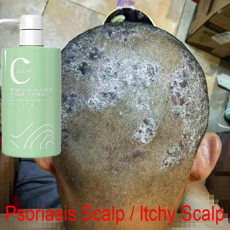 Shampo anti ketombe Shampo psoriasis Anti gatal shampo Shampo Anti Ketombe Oil control Shampo anti k