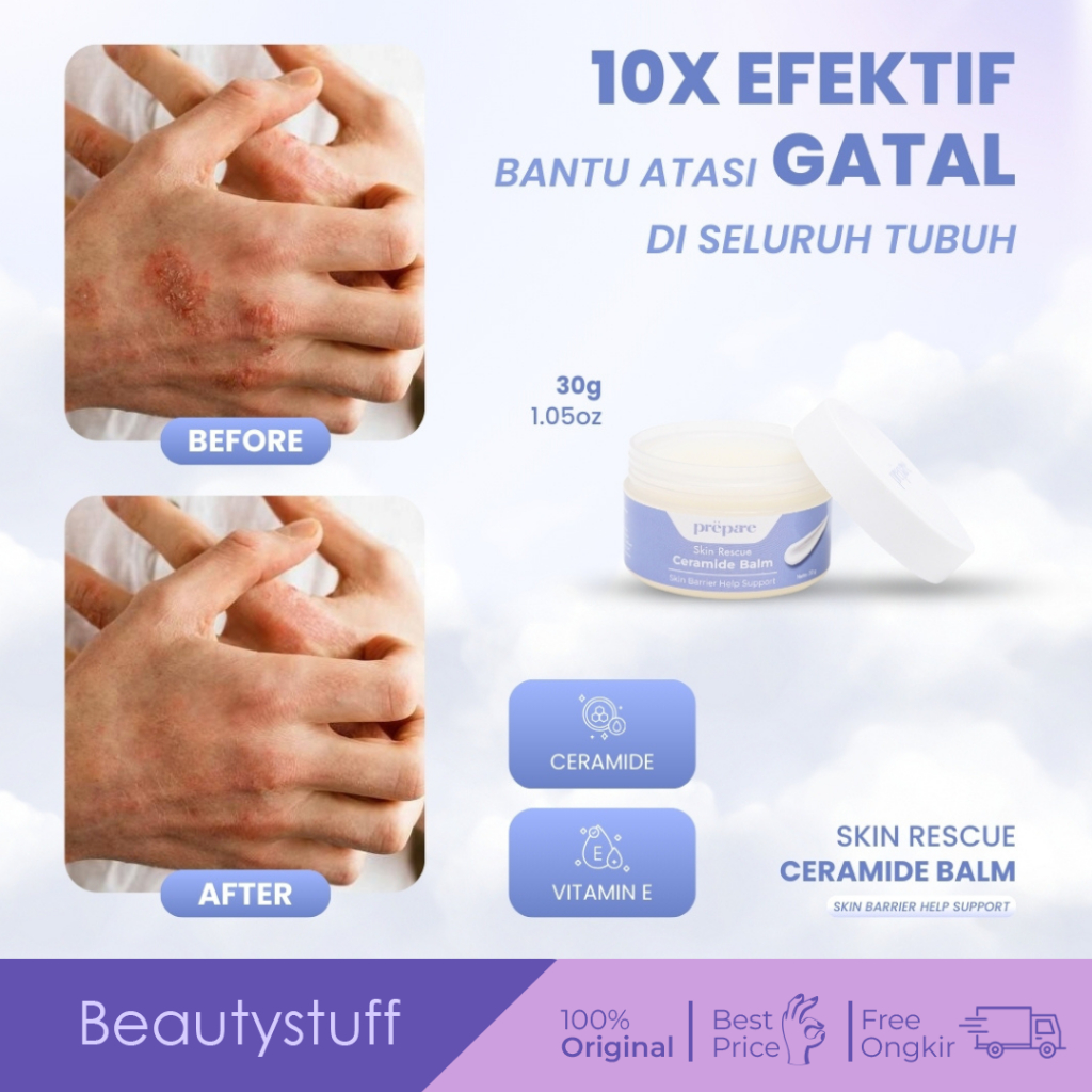 Prepare - Salep Eksim Eczema Pelembab Kulit Kering Tangan Kaki Bekas Jerawat Punggung Gatal Gatal
