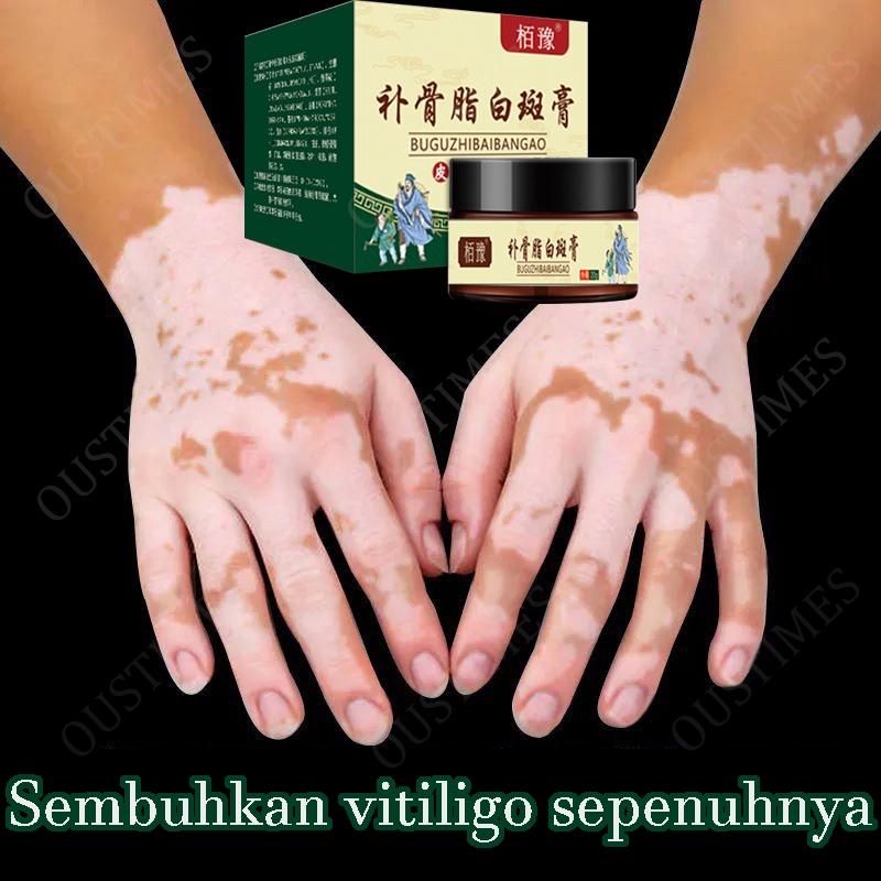 Salep vitiligo membantu pertumbuhan melanin , Krim vitiligo Pengobatan Vitiligo obat vitiligo ampuh 