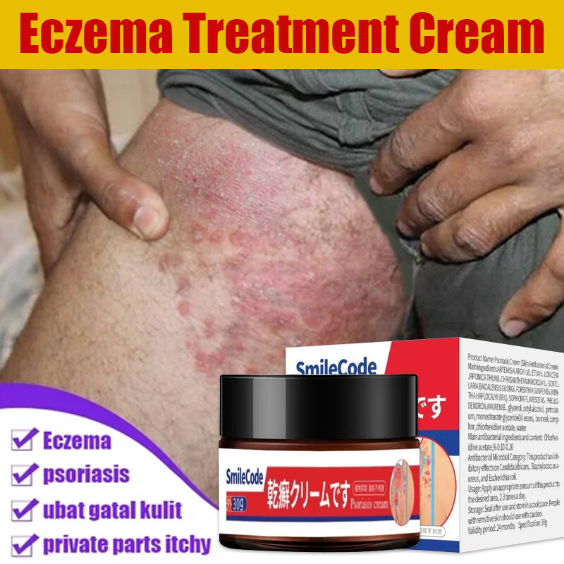 Krim psoriasis merek SmileCode, salep khusus, psoriasis, obat anti gatal, eksim, salep psoriasis pal