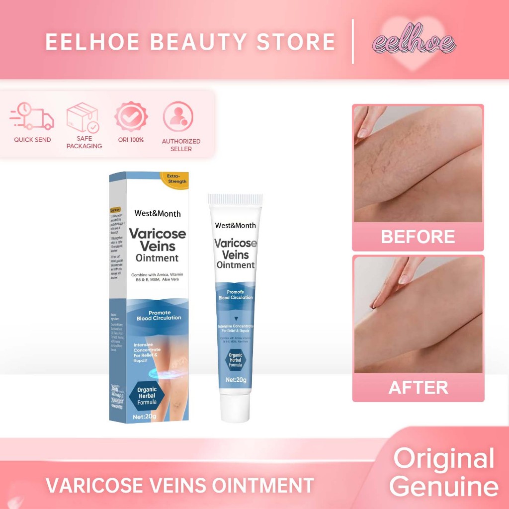 South Moon Varicose Veins Cream 30g Obat Varises Salep Obat Varises Kaki Penghilang Varises Di Kaki