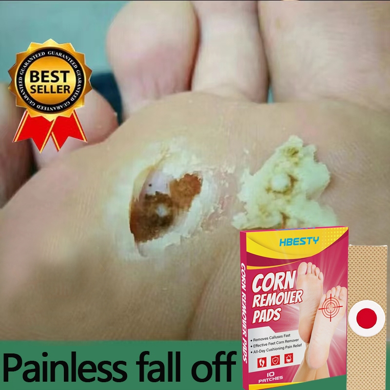 Plester Mata Ikan Plester Obat Kutil Foot Corn Removal Penutup Kutil Obat Mata Ikan Kapalan Caplak p