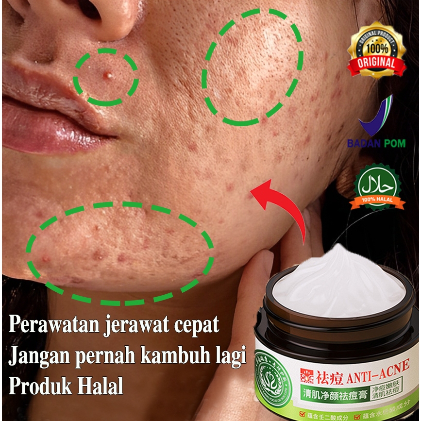 Acne Cream alat jerawat dan bekas jerawat 30g Rumus herbal menghilangkan bekas jerawat-mengecilkan p