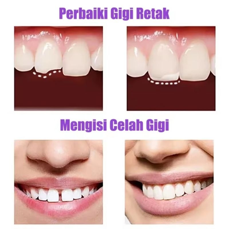 [DS] TEMPTOOTH TAMBAL GIGI Penambal gigi lem tambal gigi berlubang temptooth