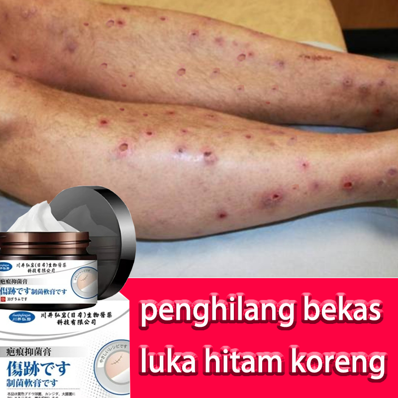 Japan Penghilang bekas luka hitam koreng Penghilang bekas luka di kaki Penghilang Bekas cacar Bekas 