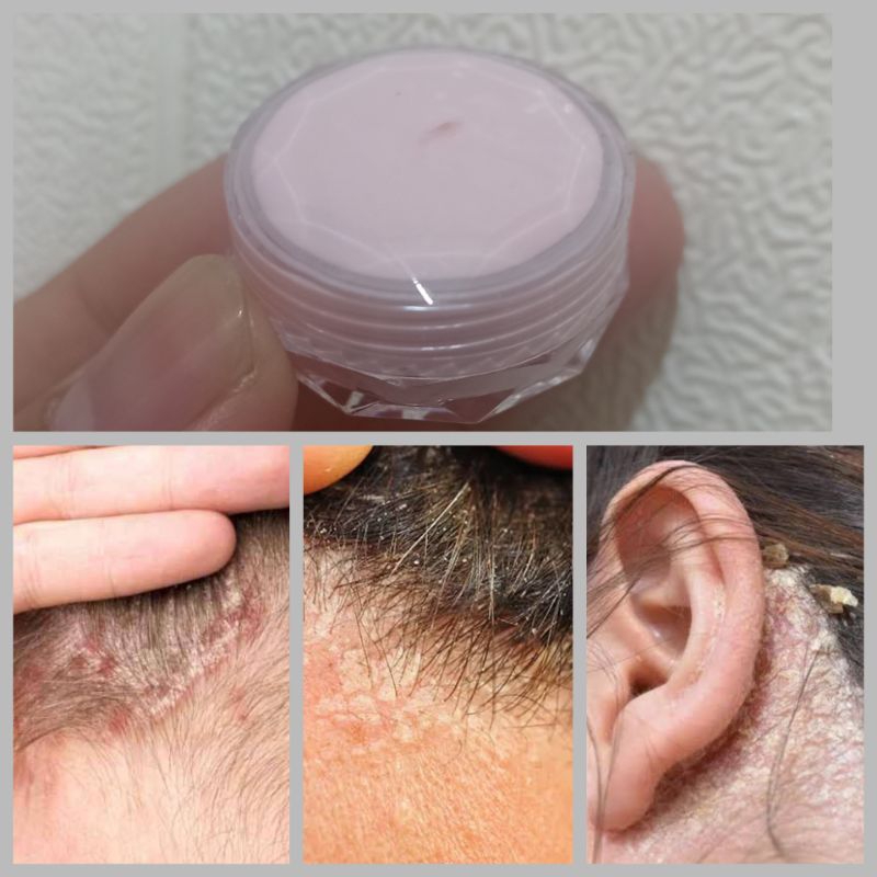 Terlaris Salep Racikan Dermatitis Seboroik Ampuh