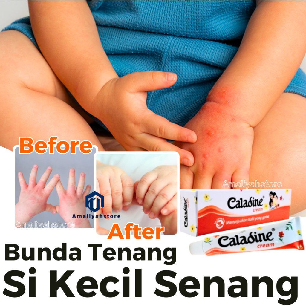Caladine Lotion Kulit Gatal Obat Salep Cream Penghilang Gatel Panu Kurap Eksim Cepat Hilang Ampuh