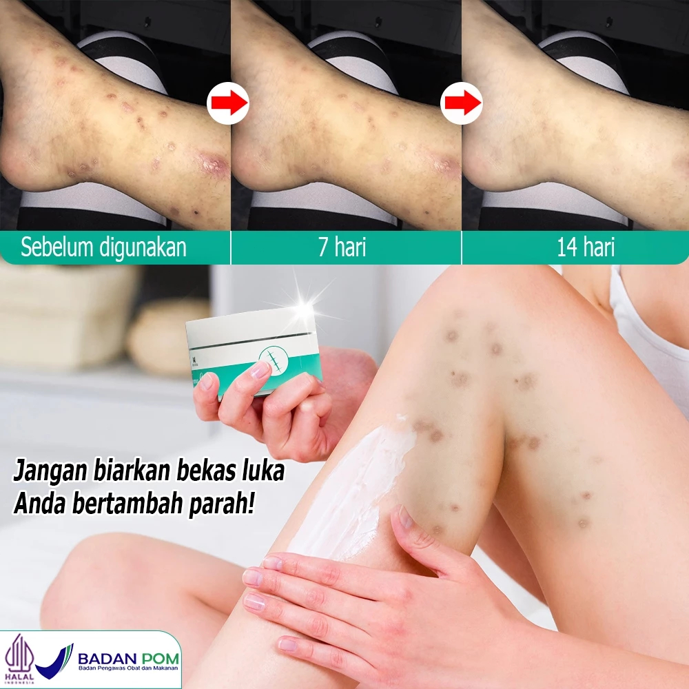 Salep penghilang bekas luka Obat penghilang bekas luka Salep penghilang bekas luka hitam Penghilang