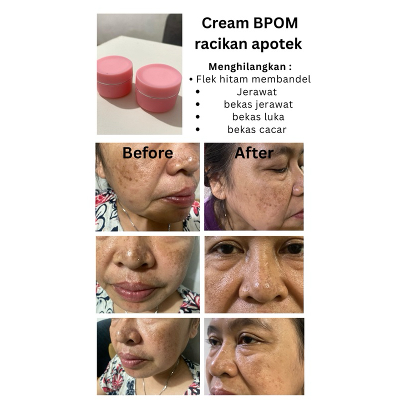 cream flek hitam/jerawat/bekas jerawat/cacar