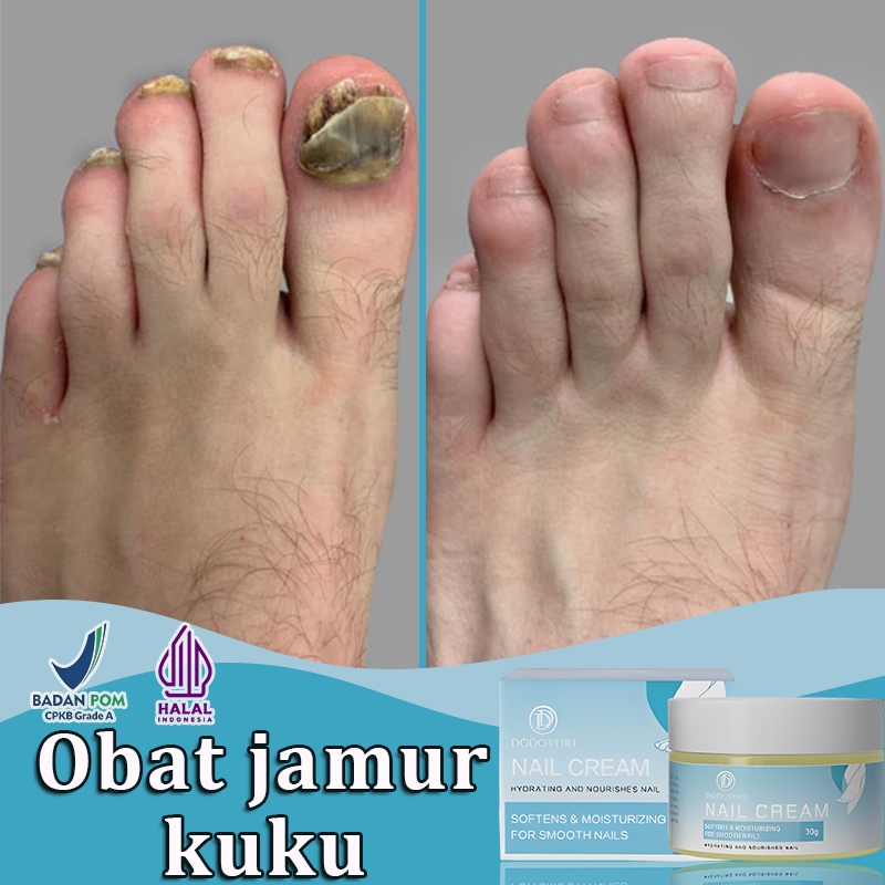【BPOM】Obat jamur kuku obat kuku jamur dan rusak perawatan kuku serum kuku jamur dan rusak obat kuku 