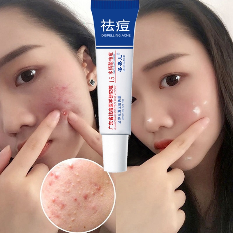 obat jerawat paling ampuh cewek / obat jerawat yang ampuh / obat jerawat / obat jerawat batu paling 