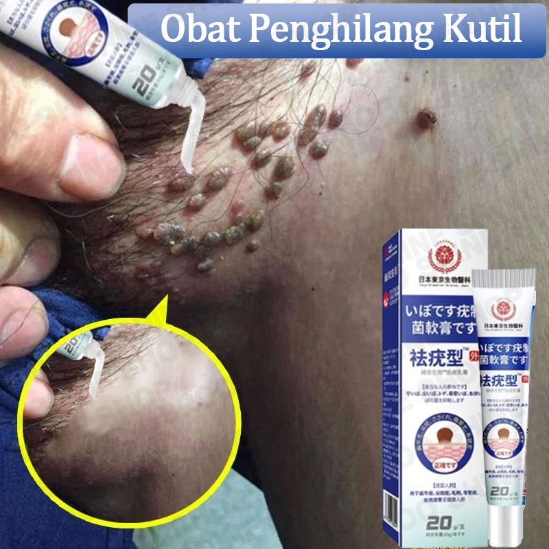 Obat Penghilang Kutil Dan Tahi Lalat Salep Kutil Paling Ampuh Wart Removal Kutilos Untuk Wajah Dan L