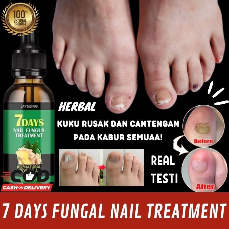 Obat Kuku Jamur Rusak Busuk Berjamur Jamuran Paling Ampuh
