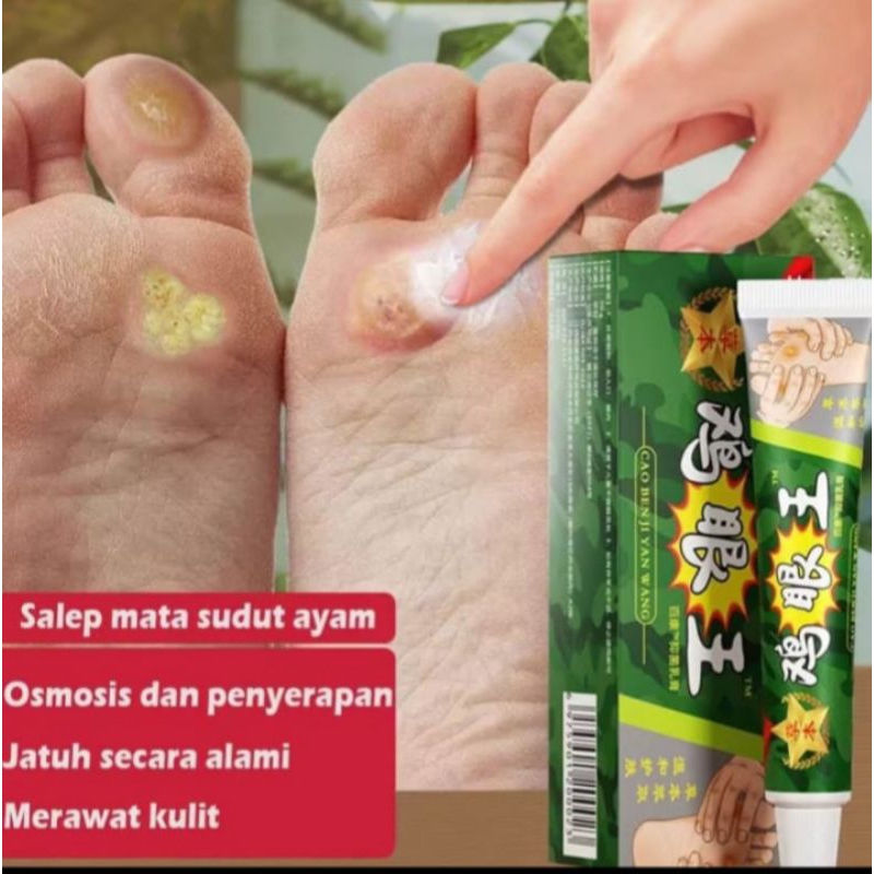Salep Kaki Kapalan Obat Mata Ikan Paling Ampuh Cream Penghilang Kutil Tahi lalat 20gr
