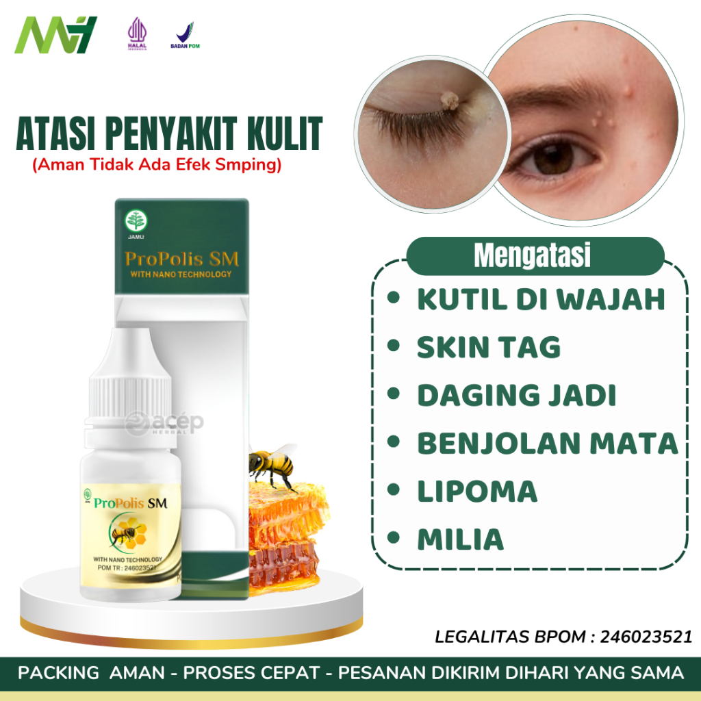 Obat Tetes Kutil, Penghilang Kutil Di Wajah Skin Tag Bruntusan Milia Benjolan Di Mata Kalazion Mata 