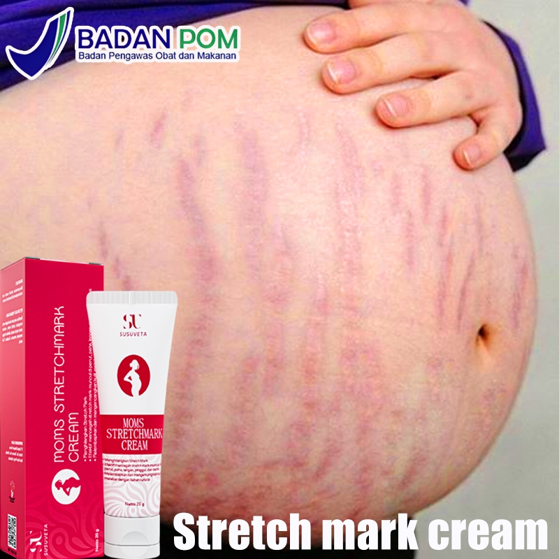 Stretch Mark Cream Cream Strechmark Ibu Hamil Cream Stretch Mark Paling Ampuh 20G Strechmark Oil Strechmark Cream Ibu Hamil Strechmark Cream Stretch Mark Paling Ampuh Strechmark Aman Untuk Ibu Hamil Dan Menyusui Menghilangkan Stretch Mark Dan Mengembalika
