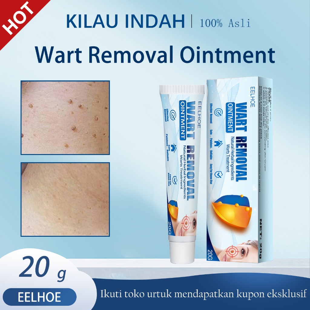 EELHOE Salep Kutil 20g - Salep Obat Kutil /Obat Kutil Ampuh Obat Penghilang Kutil