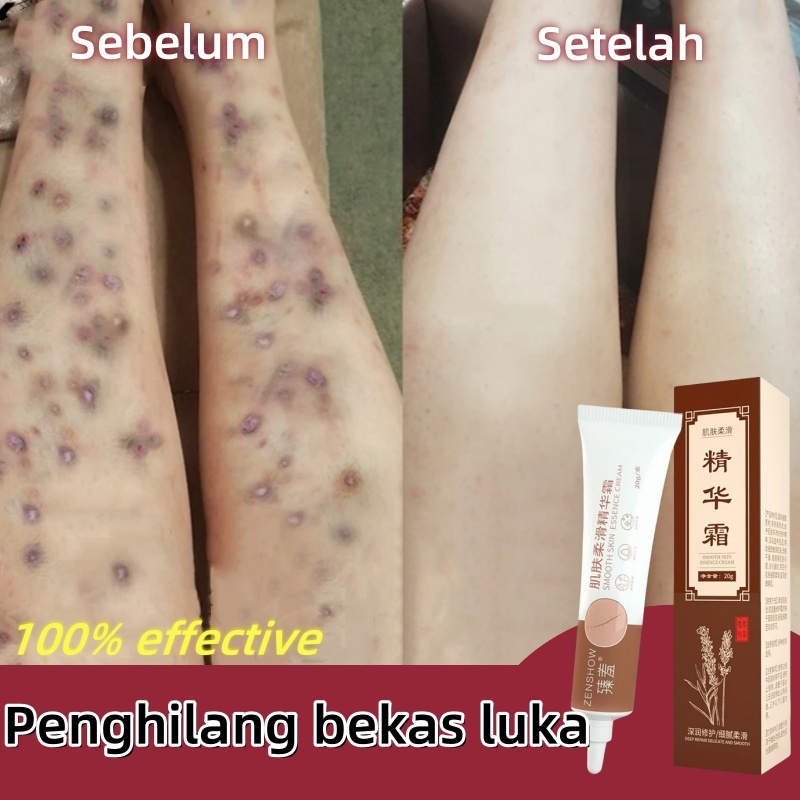 Reydokurniawan Penghilang Bekas Luka Bekas Koreng Hitam Koreng Penghilang Bekas Luka Di Kaki