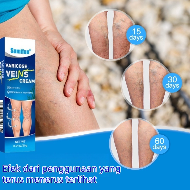 Obat Varises varicose veins cream salep varises salep varises paling ampuh penghilang varises di