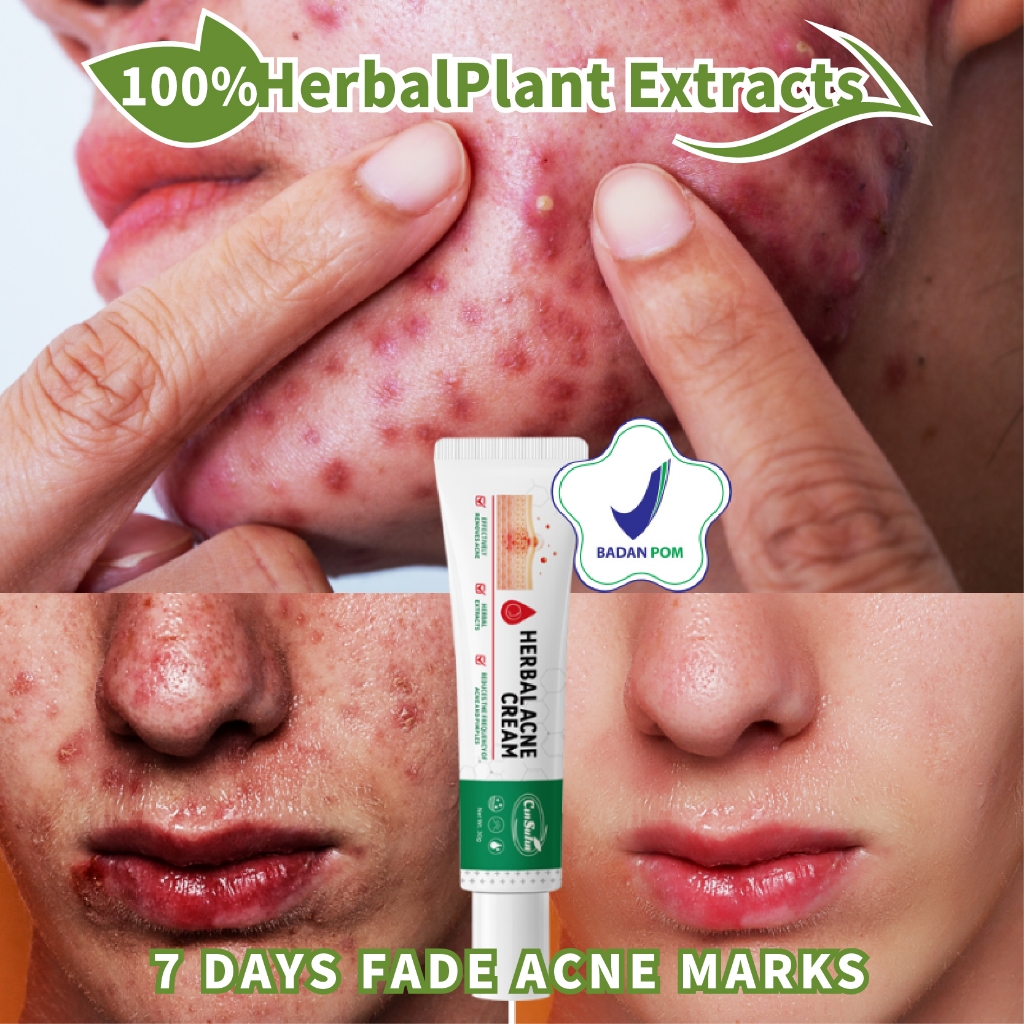 【BPOM】krim penghilang jerawat herbalife original 100%,krim jerawat dan bruntusan,krim jerawat efekti