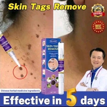 eelhoe remover penghilang kutil wart remover pen