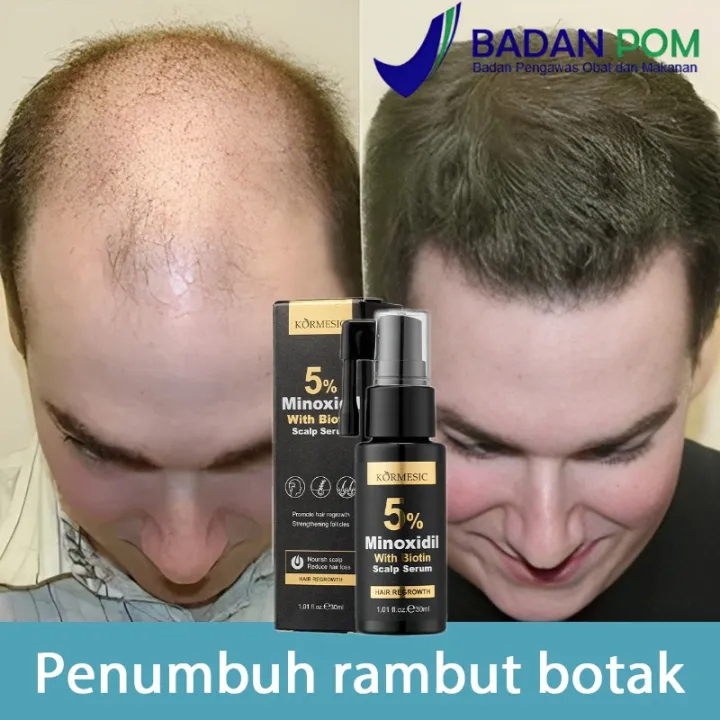 Minoxidil Penumbuh Rambut serum Obat Penumbuh Rambut Botak Tipis Dan Rontok Super Cepat Original Amp