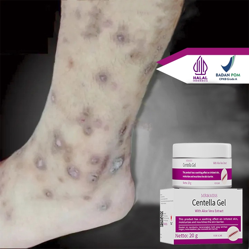 loli Penghilang bekas luka hitam koreng penghilang bekas luka anak salep penghilang bekas luka obat