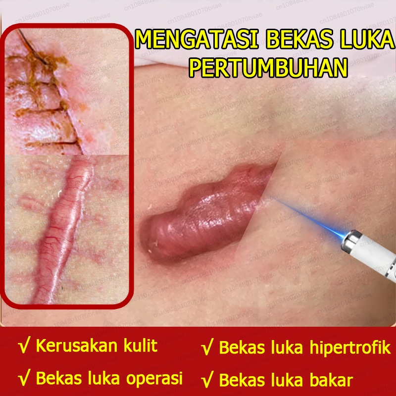 Pena laser penghilang bekas luka cocok untuk bekas jerawat, stretch mark, dan berbagai bekas luka ba