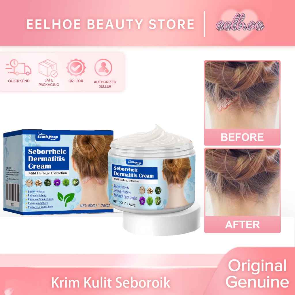 SOUTH MOON Seborrheic Dermatitis Cream 50g Psoriasis Cream Salep Psoriasis Salep Psoriasis Ampuh Pso