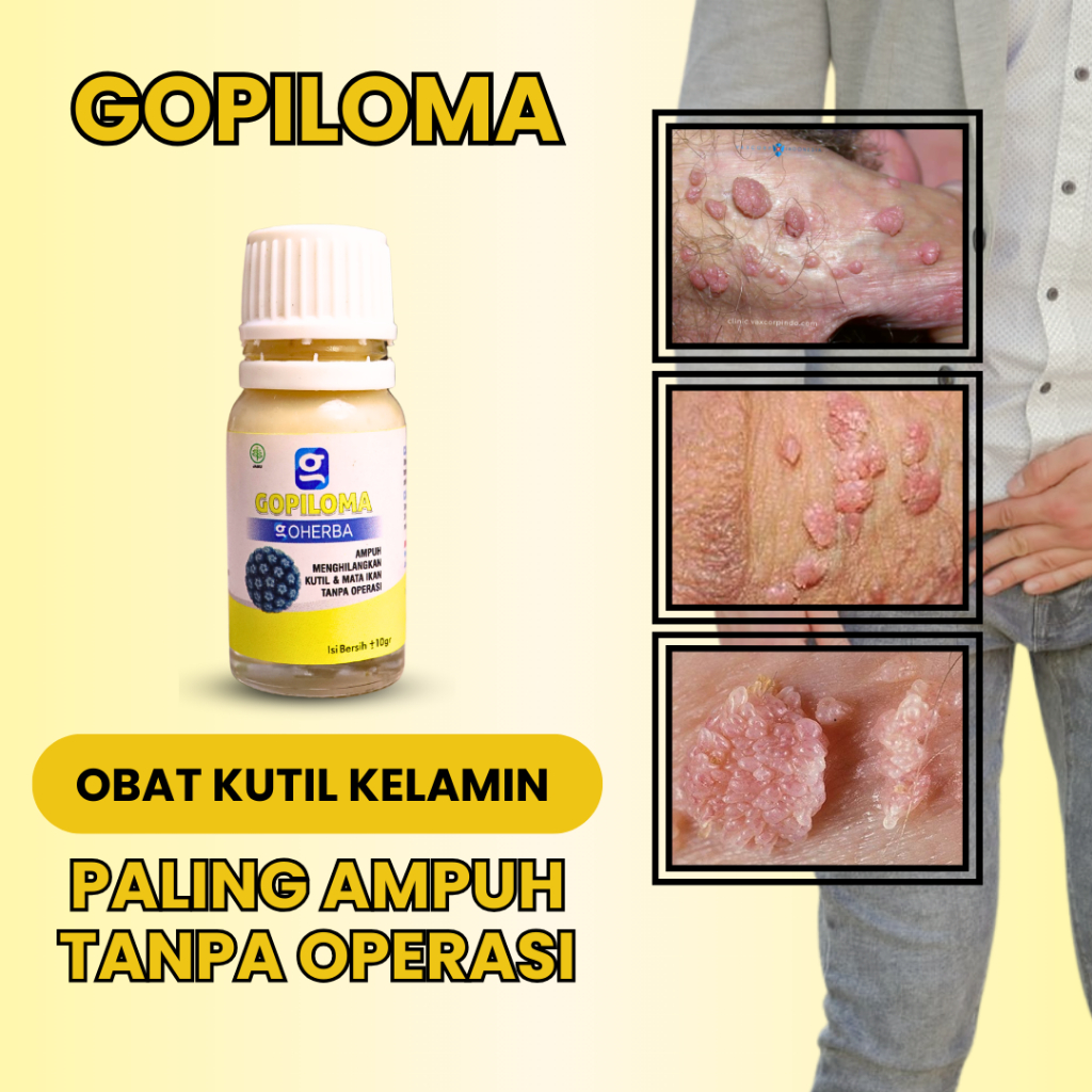 Salep Kutil Kelamin Laki Laki & Wanita - GOPILOMA - Perontok Kutil Mr P Miss V Anus & Selangkangan