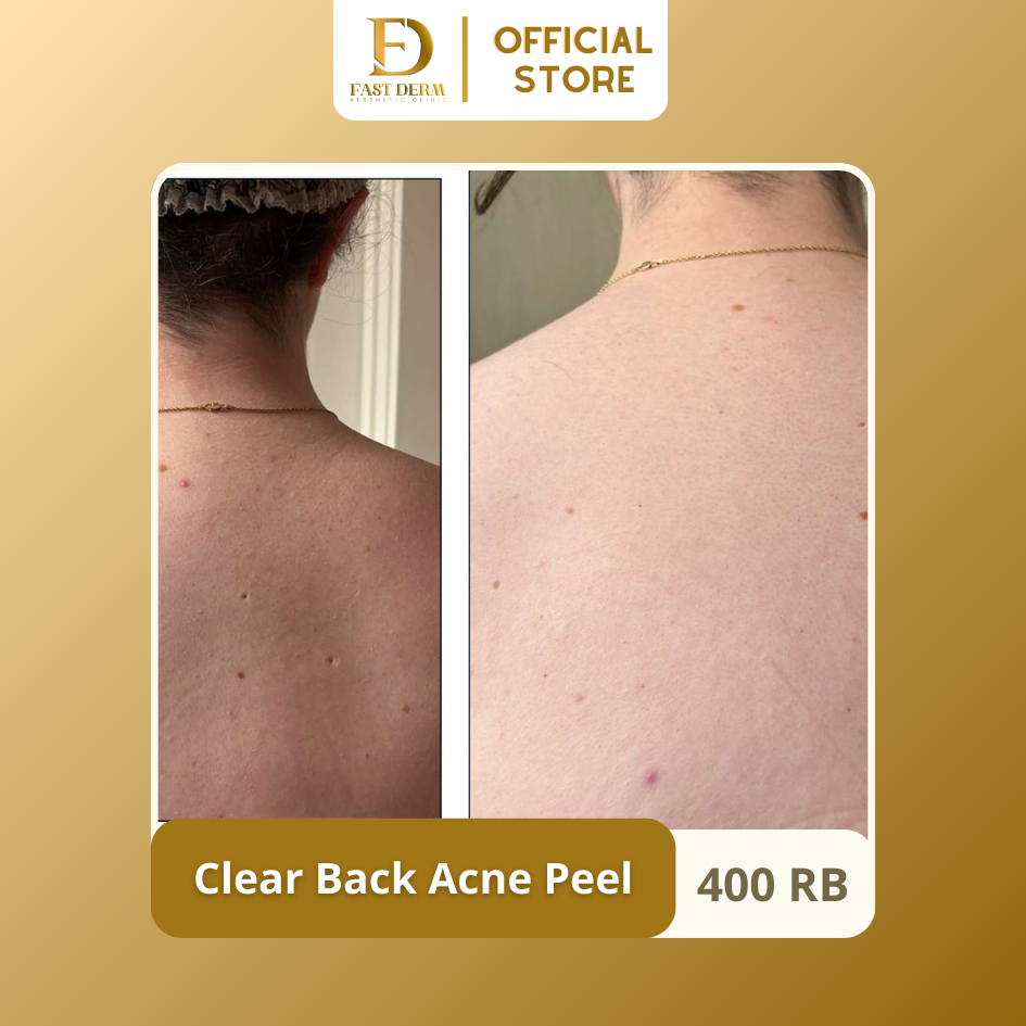 Fast Derm Aesthetic Clinic | Clear Back Acne Peel