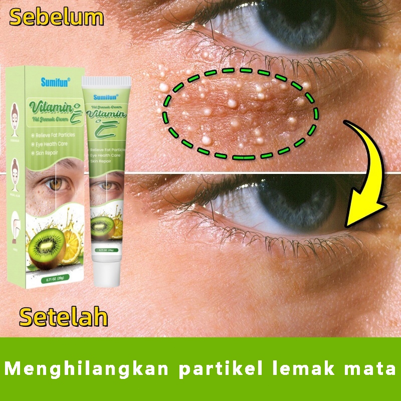 Krim milia mata/Obat Milia Di Wajah, Obat Milia di Mata, Obat Milia Di Atas / Bawah Mata, Penghilang