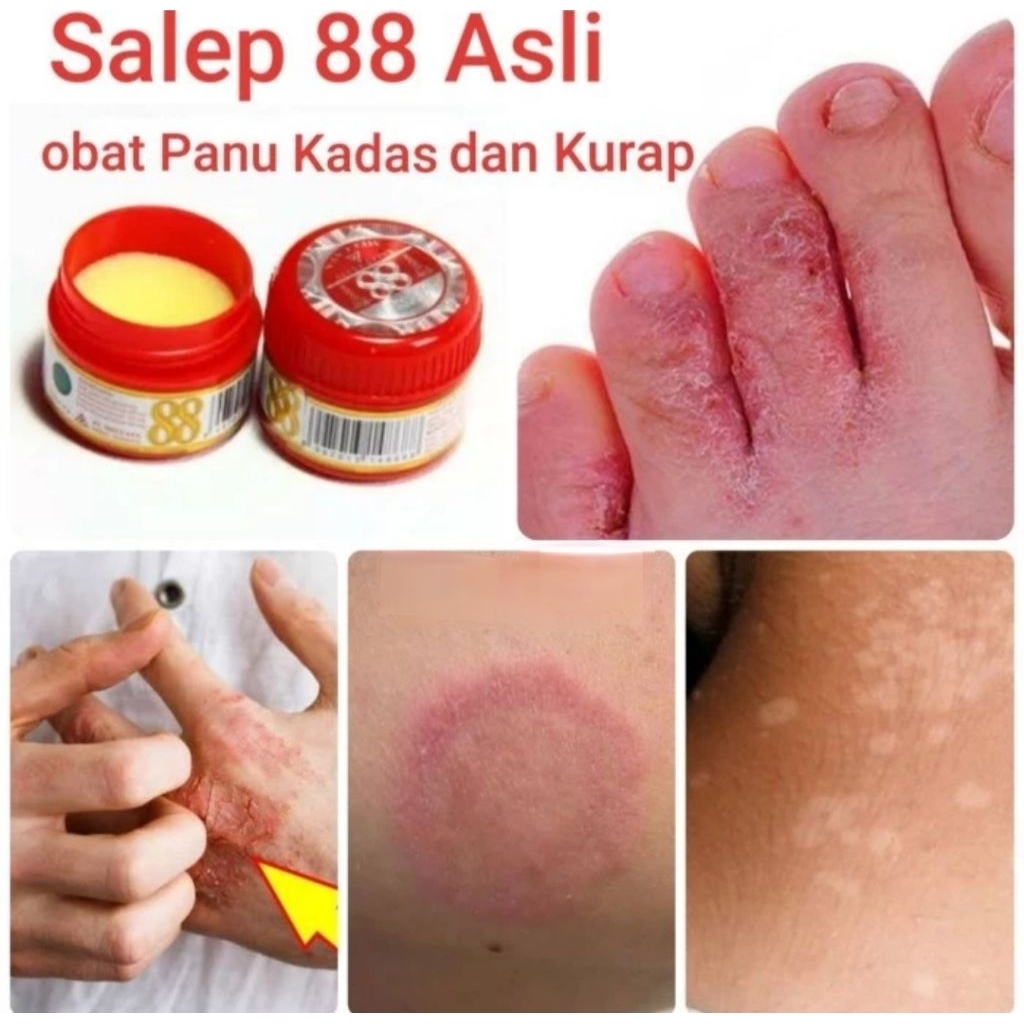 SALEP 88 OBAT KULIT PANU KURAP KUTU AIR GATAL JAMUR KADAS KUDIS