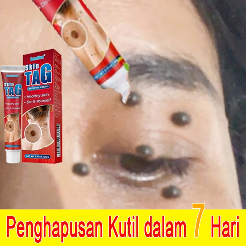 salep kutil paling ampuh obat menghilangkan kutil salep tahi lalat dan kutil salep kutil di wajah pe