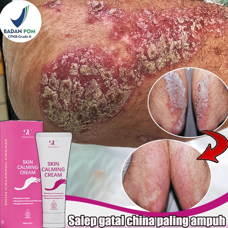 Salep gatal china paling ampuh Salep gatal selangkangan Obat kurap Salep eksim 20g salep eksim kerin