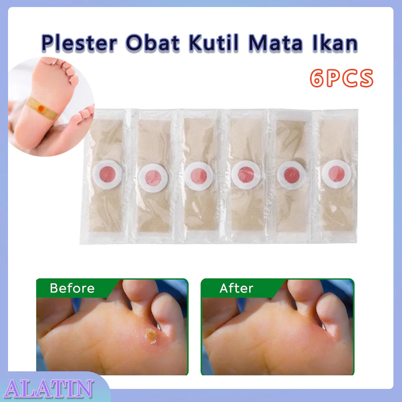 6 Pcs Plester Obat Mata Ikan / Plester Kutil / Plester Mata Ikan / Ji Yan Gao - Obat Mata Ikan