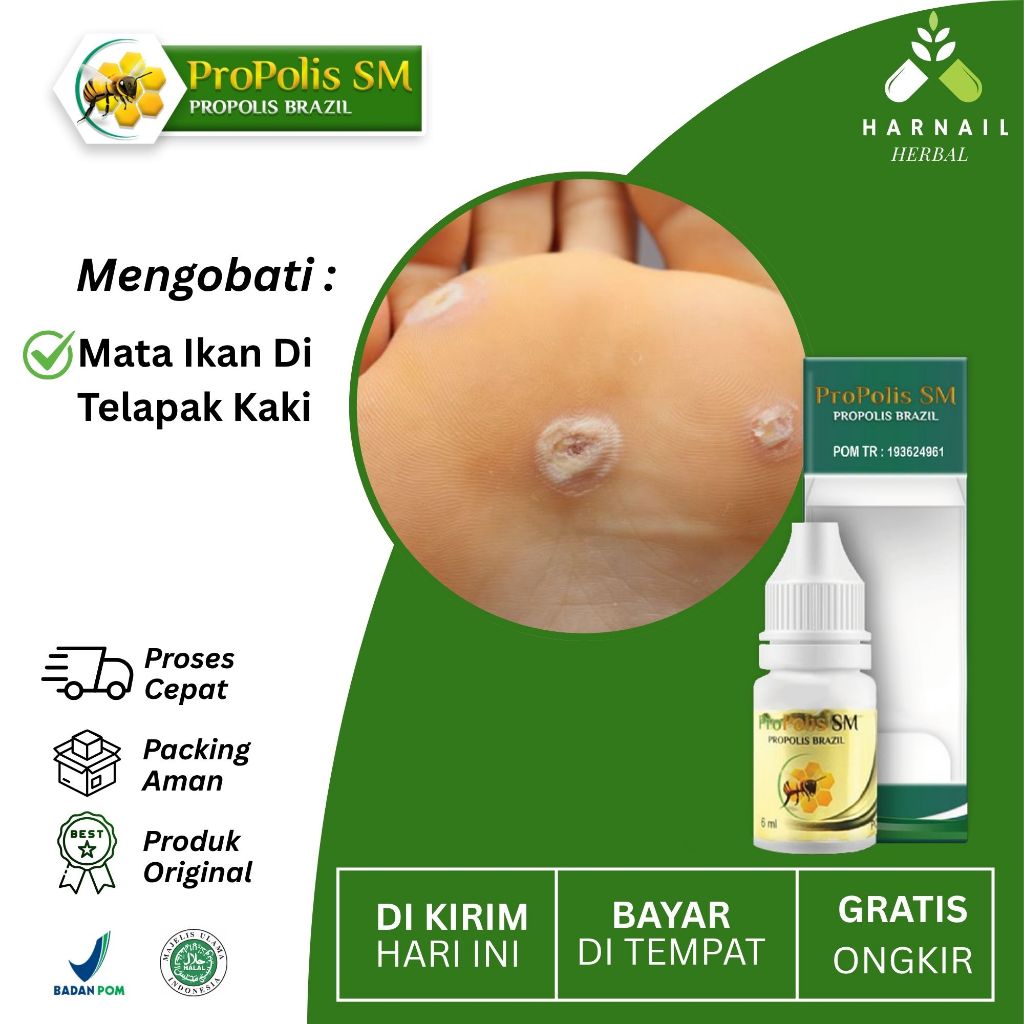 Propolis SM Obat Untuk Mata Ikan Di Telapak Kaki,Jari-Jari Kaki Untuk Anak & Dewasa