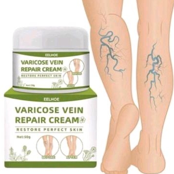 Eelhoe varicose veins repair cream menghilangkan varises
