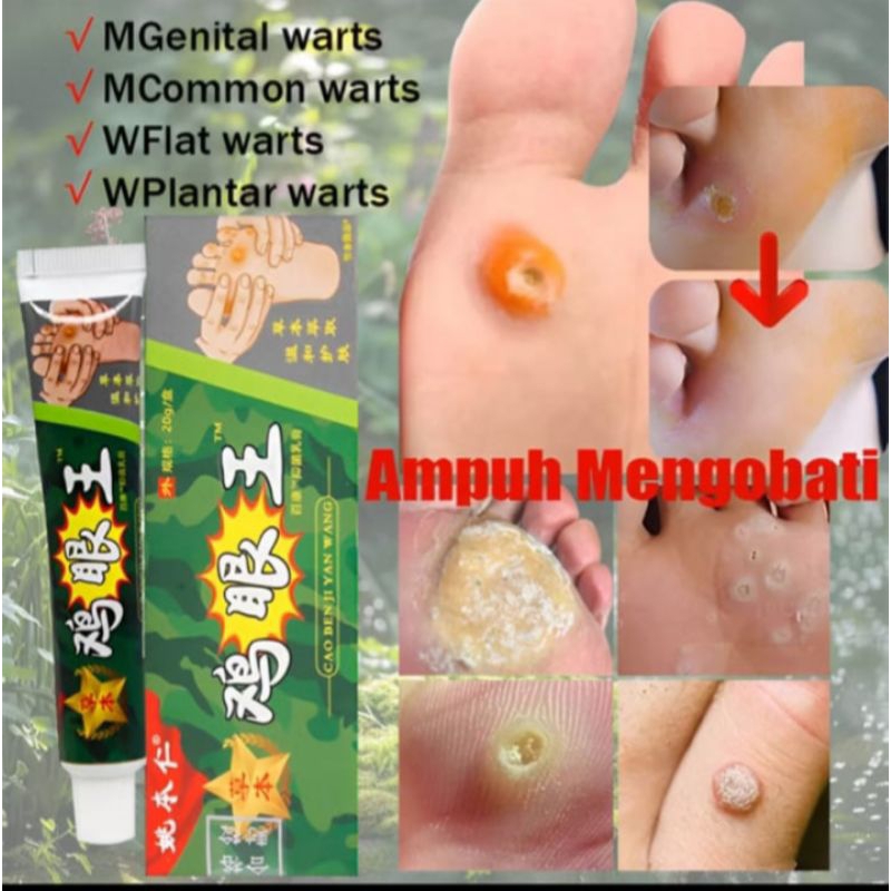 Obat Kapalan Mata Ikan Paling Ampuh Salep Penghilang Kutil Tahi lalat Cream kaki Kapalan 20gr