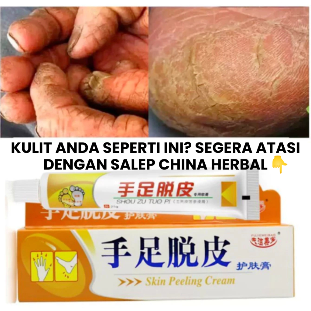 ORIGINAL Salep Herbal China Atasi Kulit Kaki Pecah-Pecah, Kapalan, Retak, Gatal Kering, Mengelupas