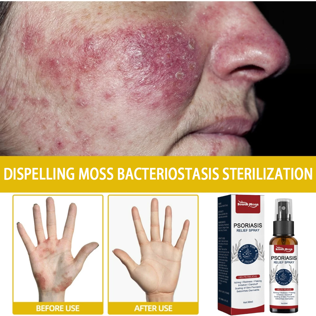 Serum Perawatan Psoriasis, Kepala, Kulit, Sisik, Psoriasis, Jamur