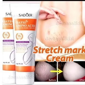 Krim Penghilang Stretch Mark Krim Stretch Mark Ori BPOM Stretch Mark Cream Penghilang Bekas