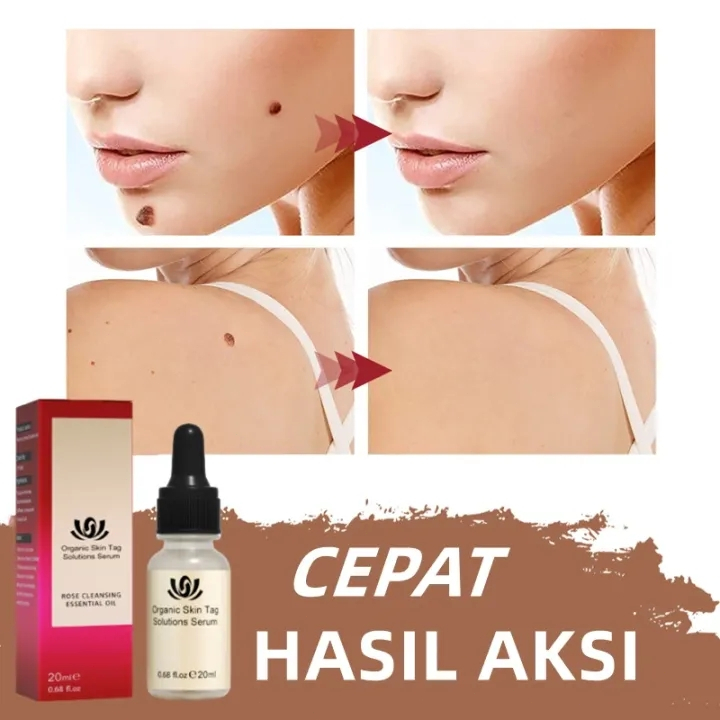 EELHOEWart Removal Serum Penghilang Tahi Lalat Penghilang Kutil Skin Tag Remover Tahi Lalat