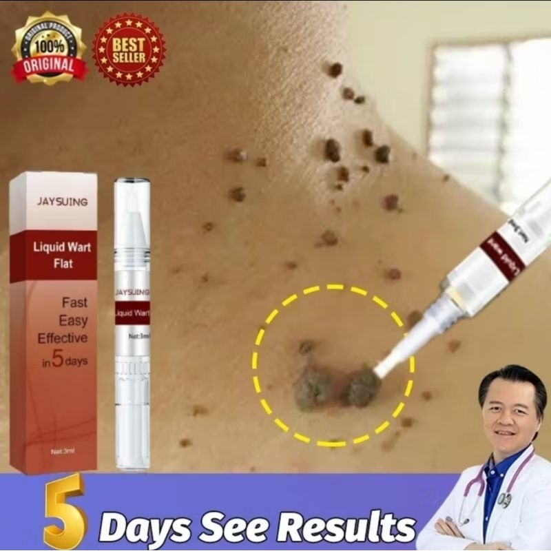 SEE_BEAUTY SEE45 Penghilang Kutil Dan Tahi Lalat Penghilang Kutil DiWajah Penghilang tahi lalat di w