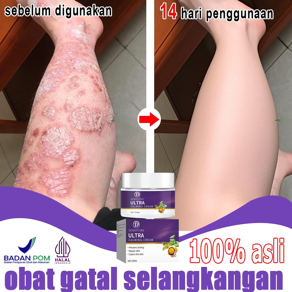【BPOM】Obat gatel salep eksim salep gatal selangkangan salep gatal china paling ampuh 20g salep jamur