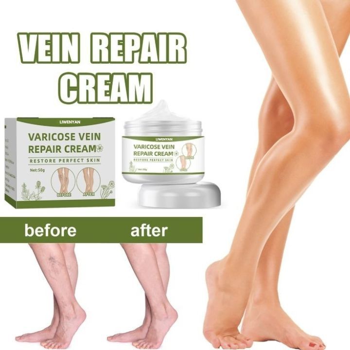 Liwenyan Salep Varises Herbal Kaki Ekstrak Tanaman Herbal Membantu Memulihkan Pembuluh Darah