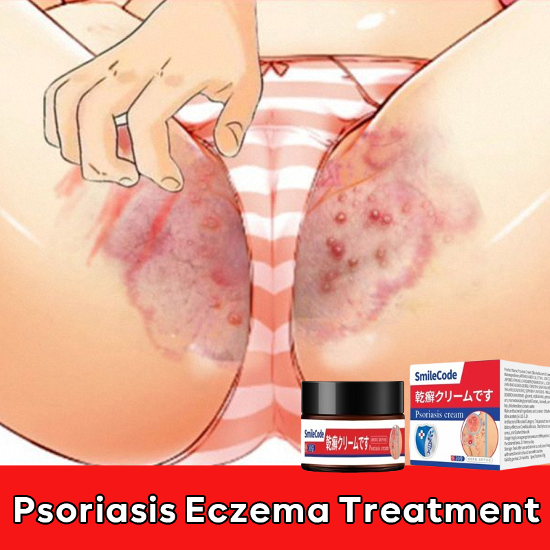 Psoriasis ointment,Salep gatal Salep psoriasis 30g Obat gatal cepat menyembuhkan gatal eksim krim ps