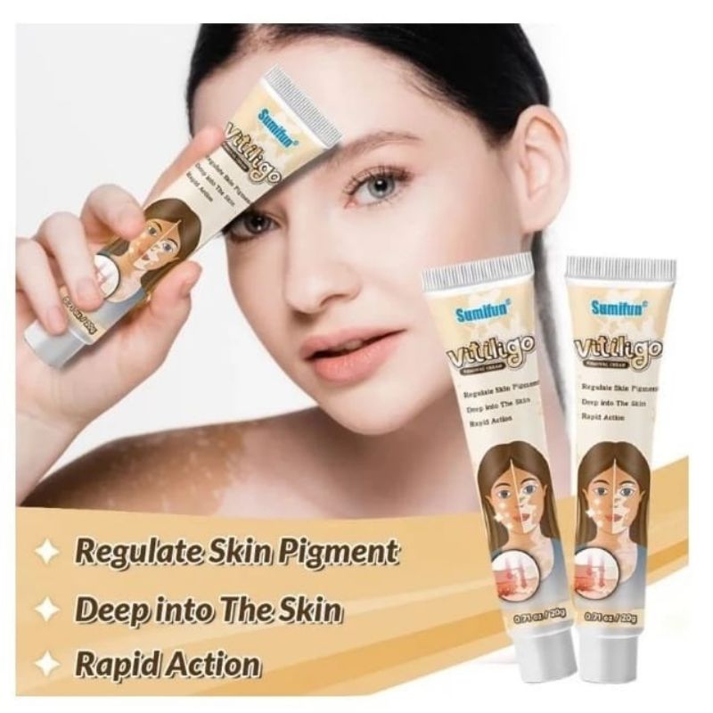 CREAM SALEP BERCAK  PUTIH KULIT BELANG  VITILIGO  SUMIFAN