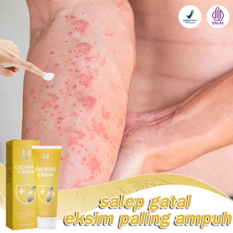Salep gatal eksim paling ampuh Salep eksim kering paling ampuh Salep gatal china paling ampuh 20g Ob