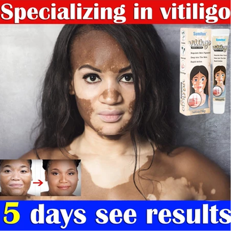 Pengobatan Vitiligo obat vitiligo ampuh /protopic Vitiligo alep vitiligo, panu, biang keringat, sale